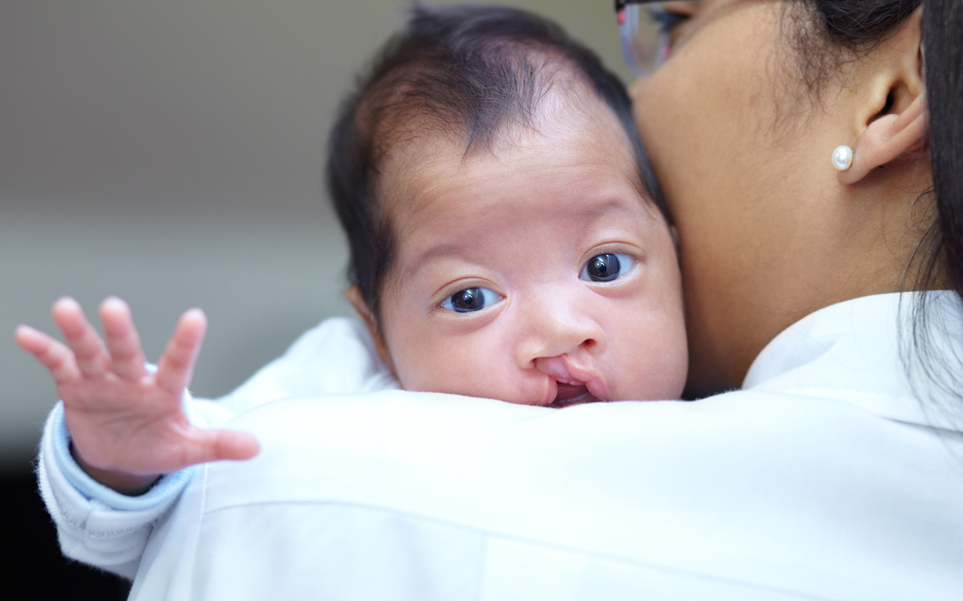 Cleft Lip and Cleft Palate Problem