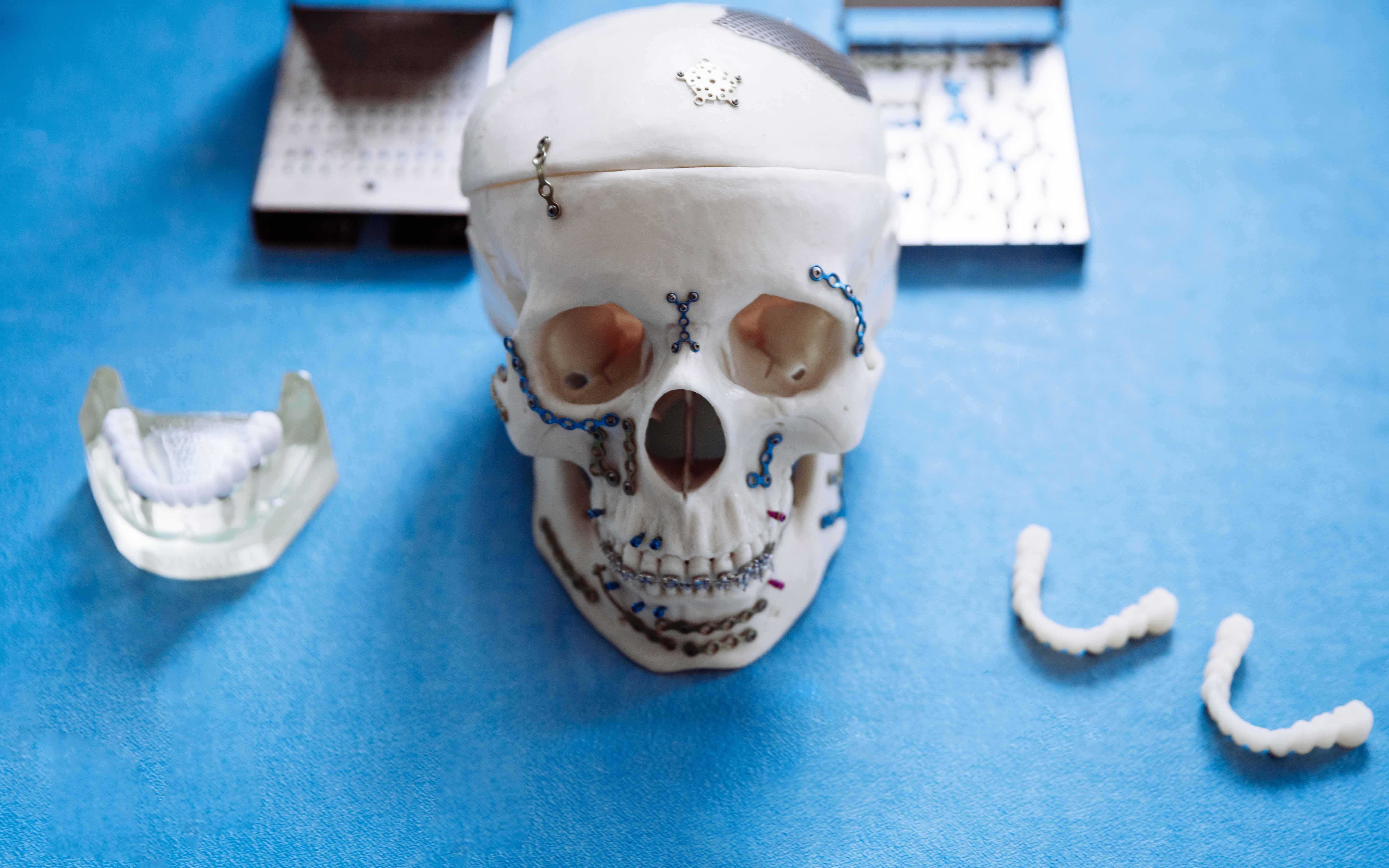 Facial Fractures
