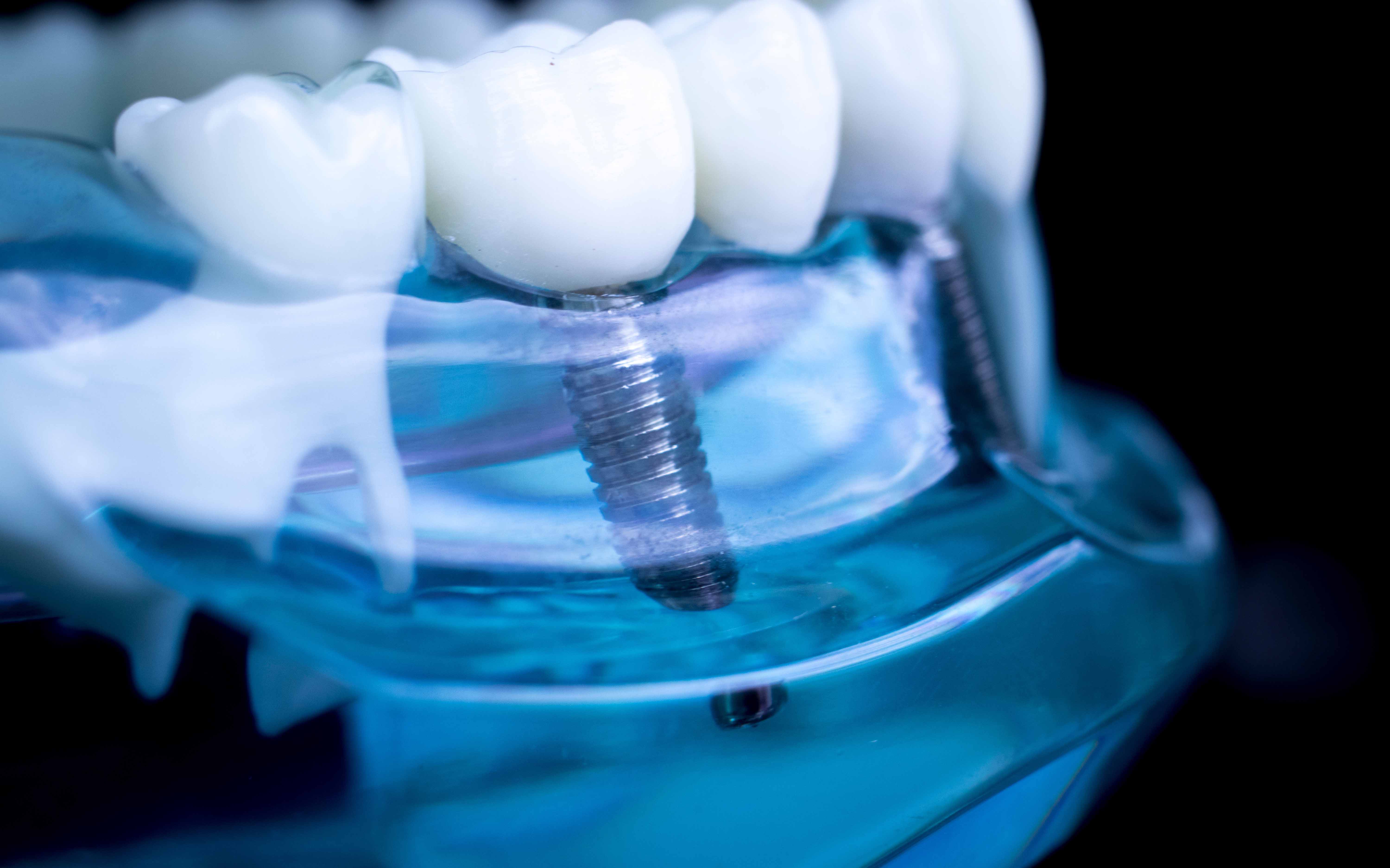 What is a Dental Implant?