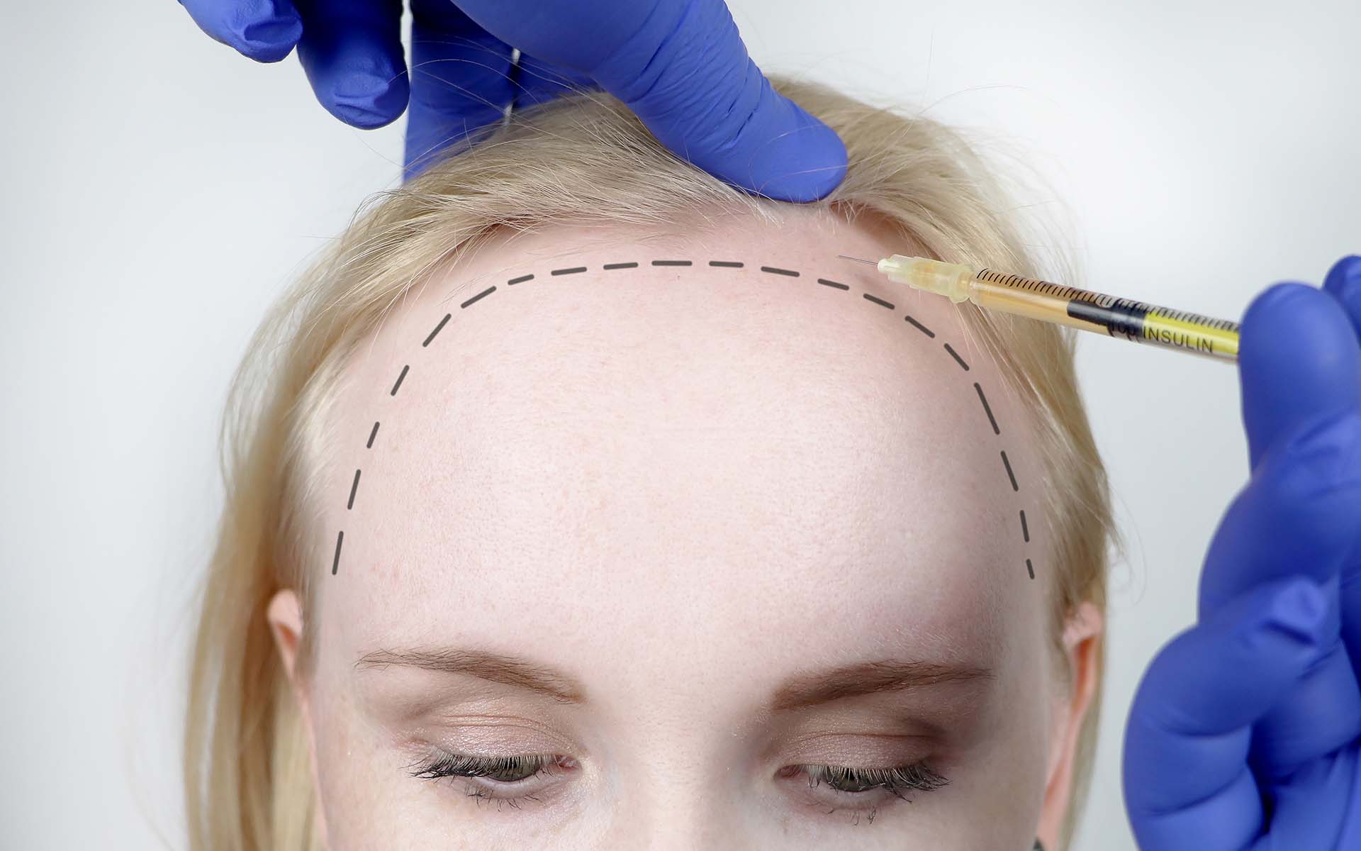 Forehead Narrowing with Fue Method in Women