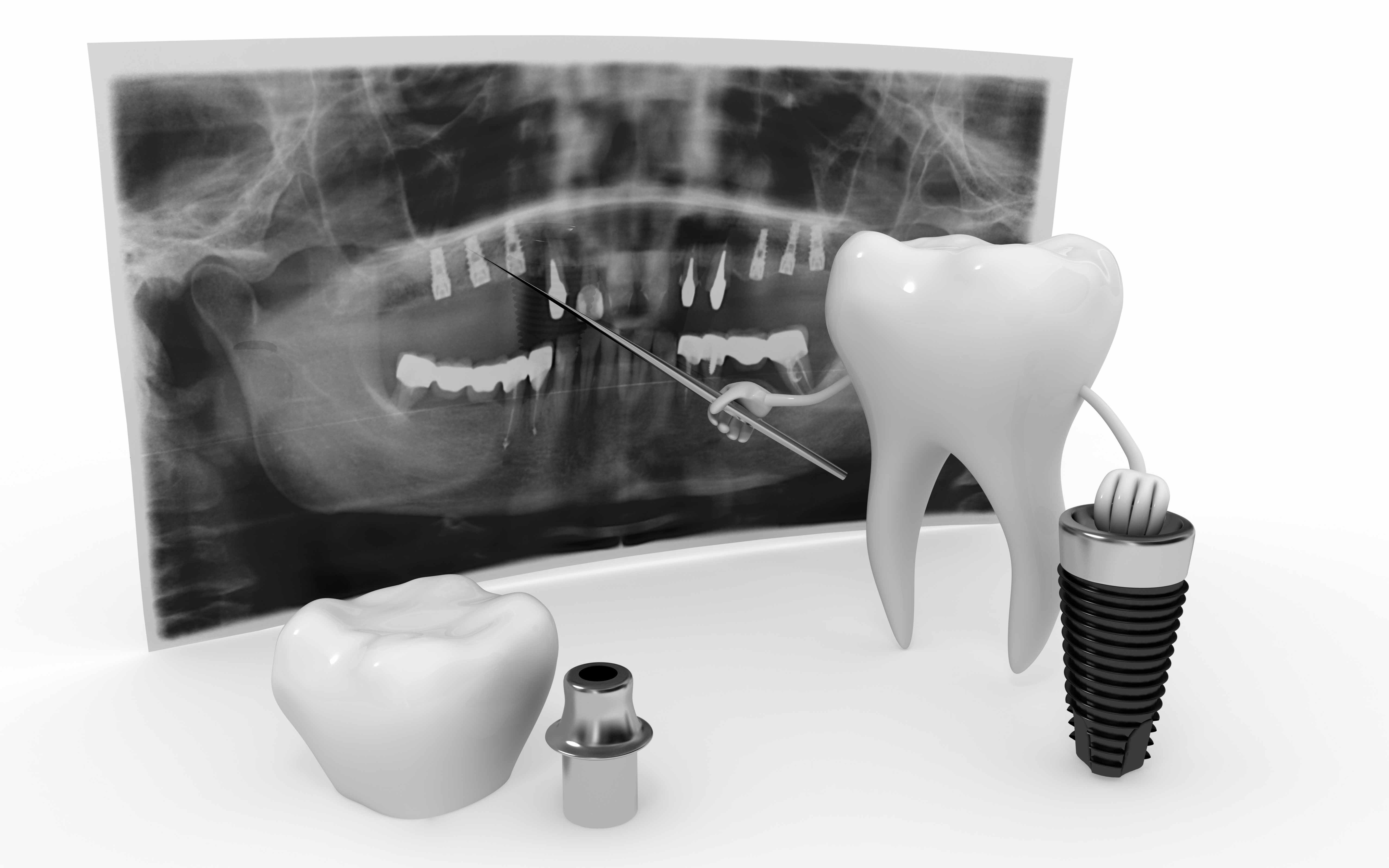 Frequently Asked Questions About Dental Implant