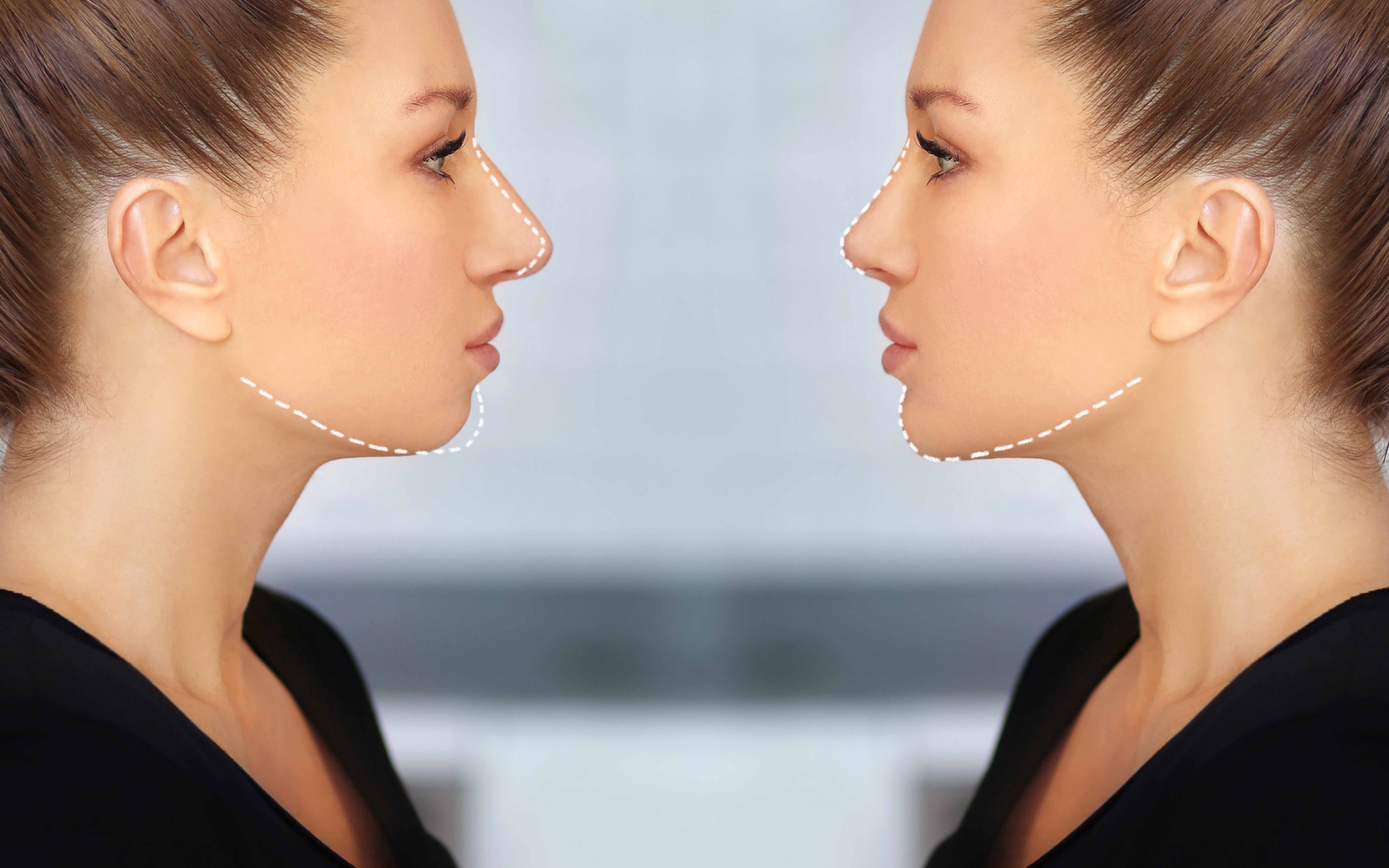 What is Genioplasty?