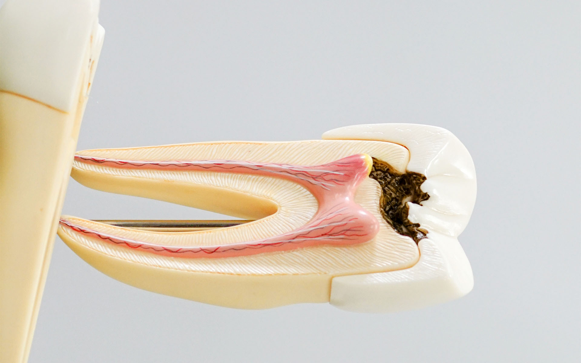 What is Pulp Necrosis? How Does It Develop?