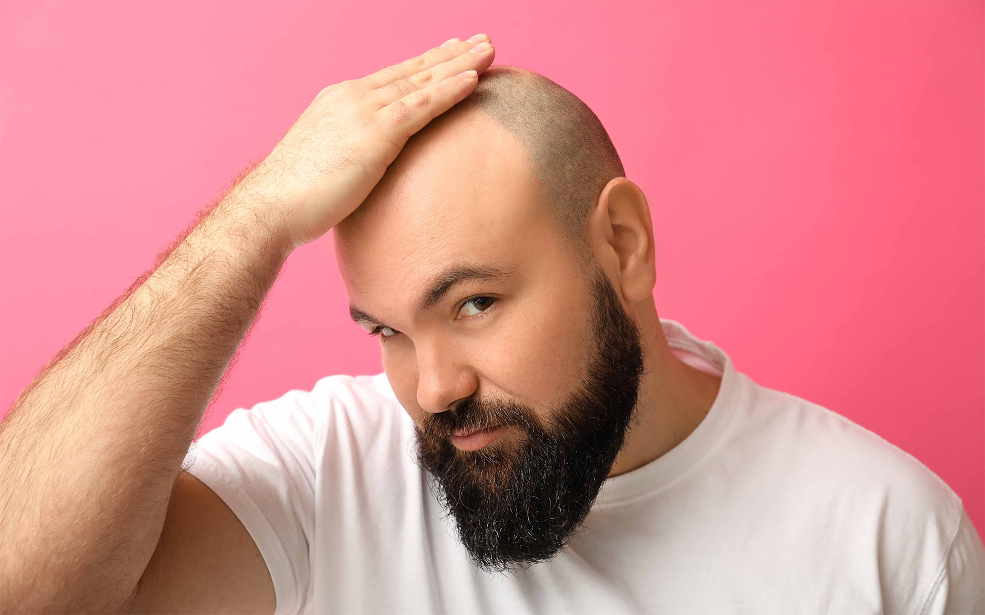 Hair Transplantation a Permanent Procedure?