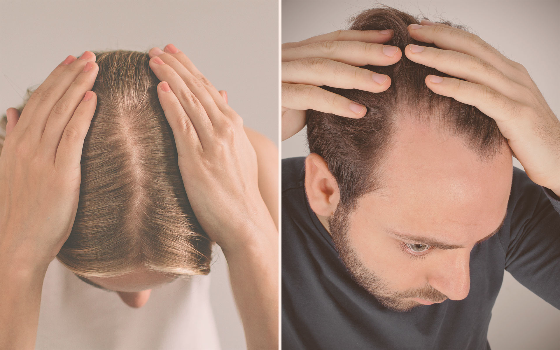 What are the Differences Between Male and Female Pattern Baldness (Androgenetic Alopecia)?